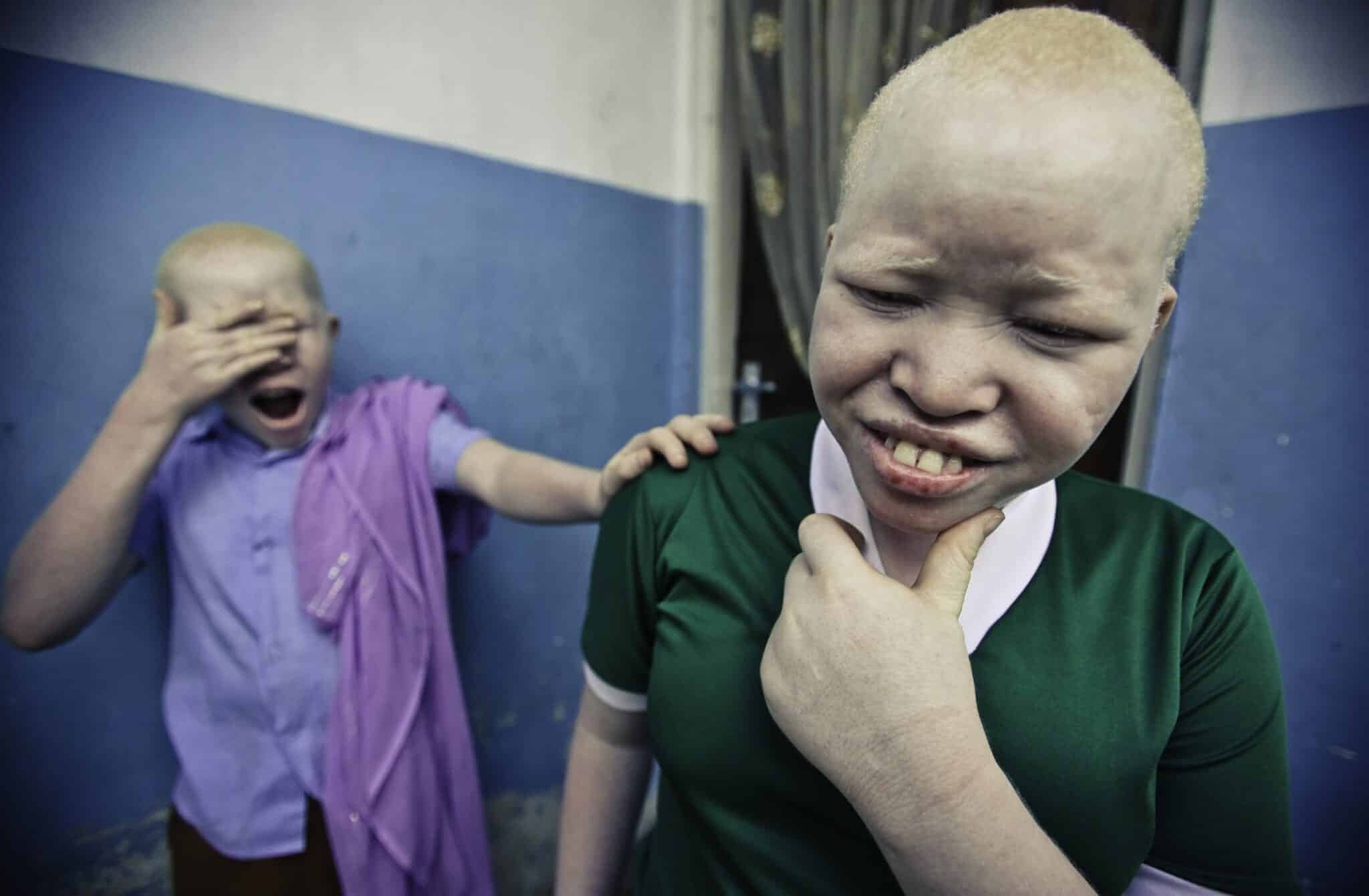 ALBINO: A STORY OF FEAR AND PREJUDICE
